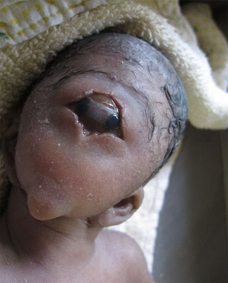 Vì vậy, hầu hết các trẻ bị Cyclopia không thể thở được bên ngoài dạ con, các em thường qua đời trước hoặc ngay sau khi được sinh ra.