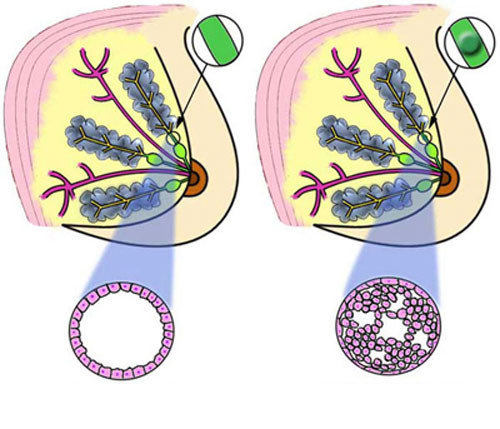 DCIS là dạng phổ biến nhất của ung thư vú lúc mới bắt đầu, gần như tất cả những phụ nữ được chẩn đoán ở giai đoạn đầu này có thể được chữa khỏi. Nếu không được điều trị, khoảng 25% số trường hợp DCIS sẽ dẫn đến ung thư vú xâm lấn trong vòng 10 năm.
