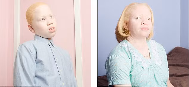 Dưới ống kính của nhiếp ảnh gia, những người mắc chứng bệnh bạch tạng hiện lên rất chân thực.