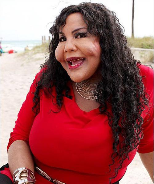 Một phụ nữ chuyển giới tên là Rajee cũng có gương mặt méo mó, cứng đơ do các hợp chất làm đầy dồn thành từng cục trên khuôn mặt.