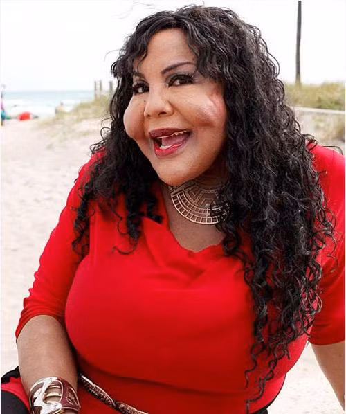 Một phụ nữ chuyển giới tên là Rajee cũng có gương mặt méo mó, cứng đơ do các hợp chất làm đầy dồn thành từng cục trên khuôn mặt.