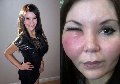 Năm ngoái, một phụ nữ tên là Jo ở London cũng gặp phải biến chứng do tiêm chất làm đầy filler. Jo tới trung tâm thẩm mỹ tư nhân để tiến hành ca bơm má. Kết quả là sau 3 năm gò má của cô cũng bị biến dạng rất đáng sợ. Thậm chí khối u cục tạo nên bởi chất làm đầy còn... di chuyển về phía não của cô Jo, đe dọa trực tiếp tới tính mạng và sức khỏe.