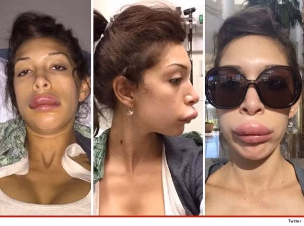 Các chuyên gia cho hay tiêm chất làm đầy filler kể cả đảm bảo chất lượng cũng có thể gây ra những hậu quả khó lường trong các trường hợp bệnh nhân mắc bệnh tự miễn, dị ứng hoặc nhạy cảm với thành phần của chất, nhiễm trùng do viêm, phụ nữ có thai và cho con bú. Sau khi được tiêm vào cơ thể, tác dụng của filler cũng không kéo dài vĩnh viễn như nhiều người lầm tưởng.