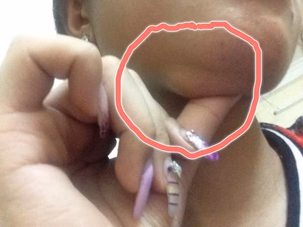 Gần đây, hàng loạt các nạn nhân đã lên tiếng tố cáo một Spa ở Việt Nam dùng chất làm đầy "dởm" khiến cho họ bị vẹo môi, mũi, thậm chí là chất làm đầy vón cục ở cằm.