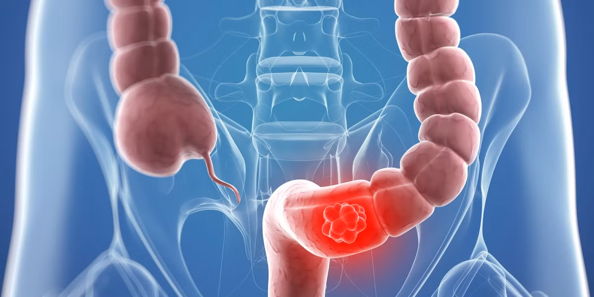 Bên cạnh lợi ích đối với ung thư vú và ung thư gan, canh miso với thành phần đỗ tương còn làm giảm nguy cơ mắc bệnh ung thư đại trực tràng. Các nghiên cứu cho biết, việc tăng cường tiêu thụ đỗ tương còn làm giảm nguy cơ ung thư đại trực tràng, đặc biệt là ở phụ nữ mãn kinh.