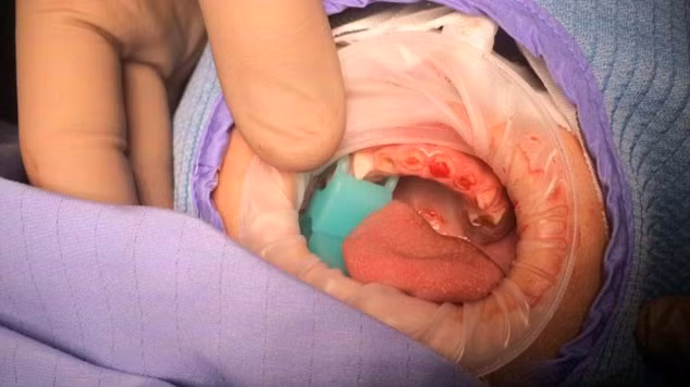 Sâu răng là do vi khuẩn trong miệng sẽ làm xói mòn bề mặt của răng, gây thiệt hại đáng kể cho cấu trúc bên trong của răng. Trong ảnh là một cậu bé 2 tuổi thương xuyên uống nước ngọt phải nhổ bỏ 6 răng.