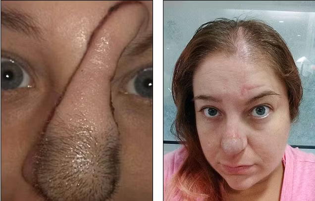 Chỉ hai năm sau, từ một chấm nhỏ trên mũi, khối u đã phát triển to như một cục tẩy bút chì. Lúc này, cô Bree Towner đã được chẩn đoán bị mắc ung thư biểu mô tế bào đáy - một dạng ung thư da phổ biến.