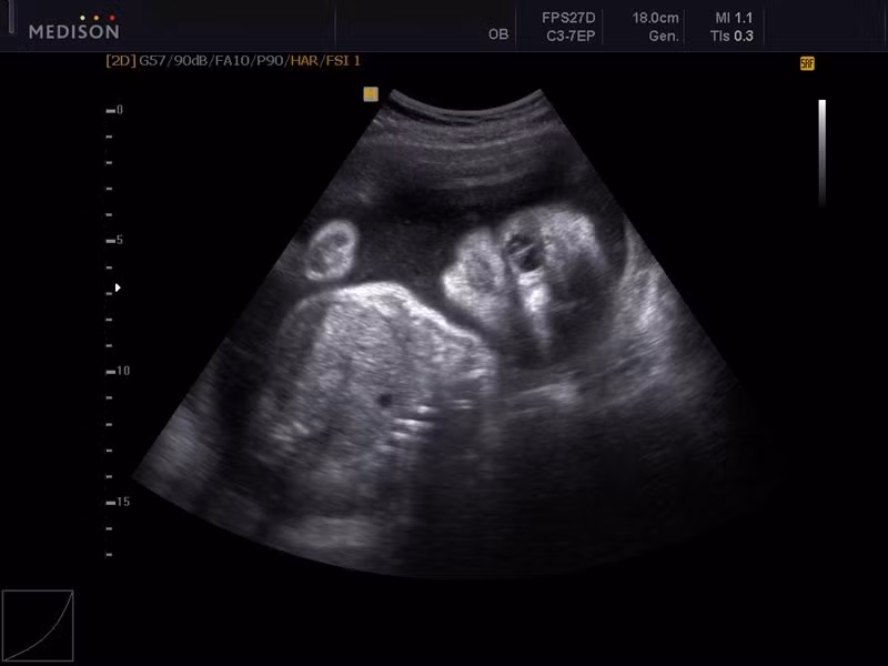 Theo lý giải khoa học, sự dị dạng này bị gây ra bởi thất bại trong quá trình hình thành não trước và khoang mũi. Do đó, hai mắt của người sẽ hình thành một mắt nằm giữa trán hoặc đằng sau đầu.