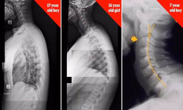 Những hình ảnh chup X-quang cho thấy trẻ em từ 7 tuổi cho đến thanh thiếu niên có xương cổ và cột sống biến dạng nghiêm trọng do suốt ngày chúi mặt vào điện thoại thông minh.