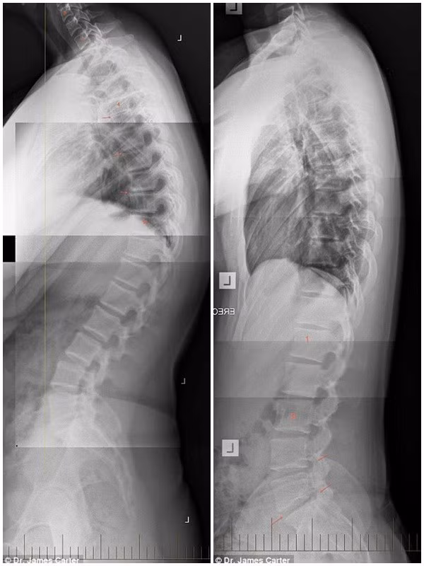 Bác sĩ Carter cảnh báo rằng hiện tượng "text neck" (tạm dịch - cổ nhắn tin) - hậu quả của việc cúi xuống nhìn màn hình quá lâu do nghiện smartphone đang dần trở thành dịch bệnh trong giới trẻ.