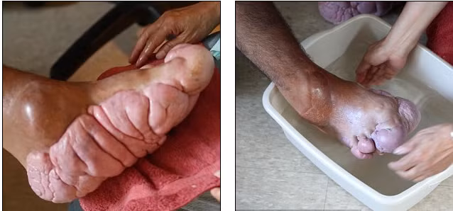 Sau 11 ca phẫu thuật chữa trị không thành công, anh Ortega muốn được cắt bỏ tứ chi và coi đây là lựa chọn tốt nhất.