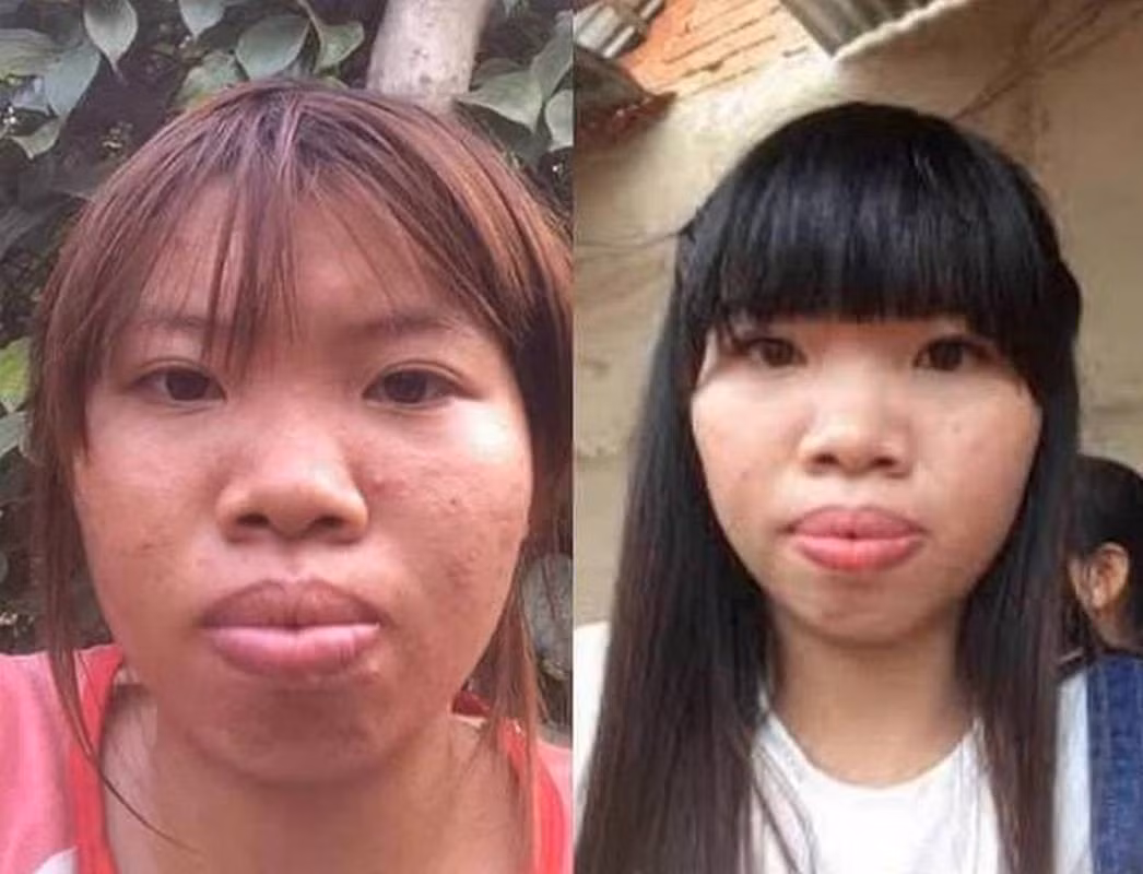 Quách Phượng dũng cảm chia sẻ hình ảnh trước khi phẫu thuật thẩm mỹ vốn đầy khuyết điểm của mình. So với hình ảnh hiện tại nhan sắc của "hiện tượng mạng" này khác một trời một vực.