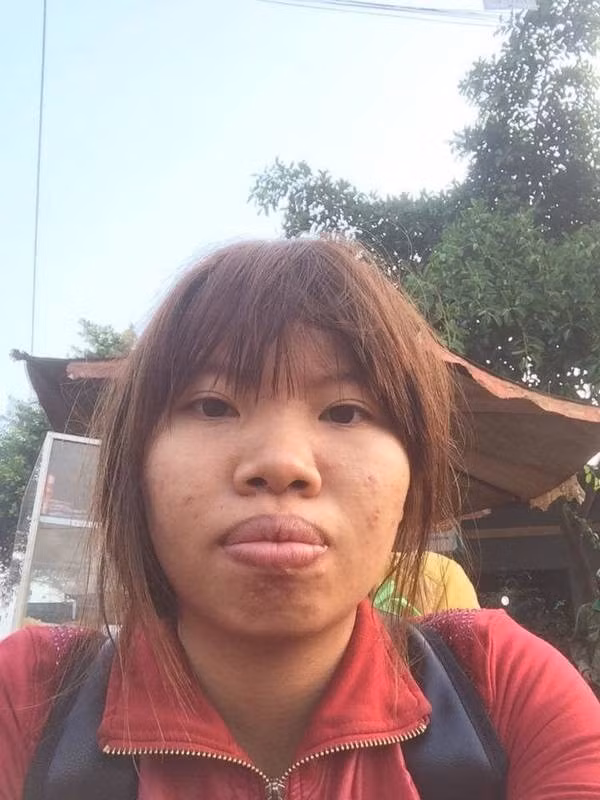 Cách đây 6 năm, Quách Thị Kim Phượng (sinh năm 1995, hiện đang sống tại thành phố Hồ Chí Minh) đã khiến cõi mạng xôn xao khi tiết lộ câu chuyện dao kéo của bản thân.