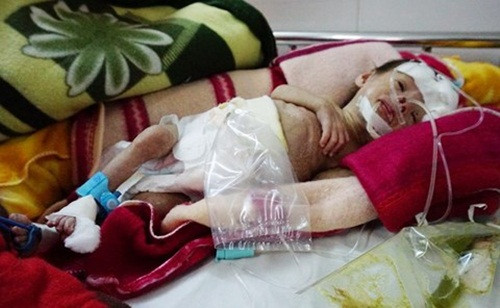 Bé Trương Văn Bảo con của vợ chồng anh Kiên, chị Đào ra đời bằng phương pháp thụ tinh trong ống nghiệm sau 7 năm chờ đợi có nguy cơ mắc bệnh Down.