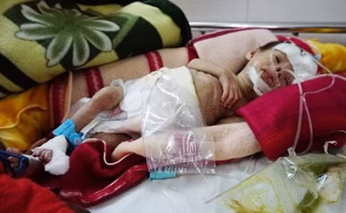 Bé Trương Văn Bảo con của vợ chồng anh Kiên, chị Đào ra đời bằng phương pháp thụ tinh trong ống nghiệm sau 7 năm chờ đợi có nguy cơ mắc bệnh Down.