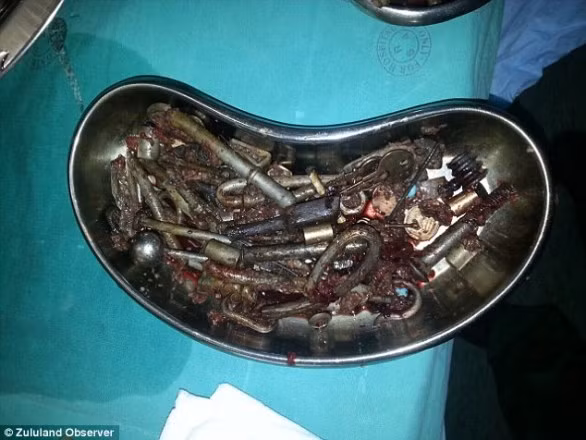 Số kim loại sau khi được bác sĩ mổ lấy ra. Các bác sĩ đã gặp rất nhiều khó khăn cho ca phẫu thuật này.