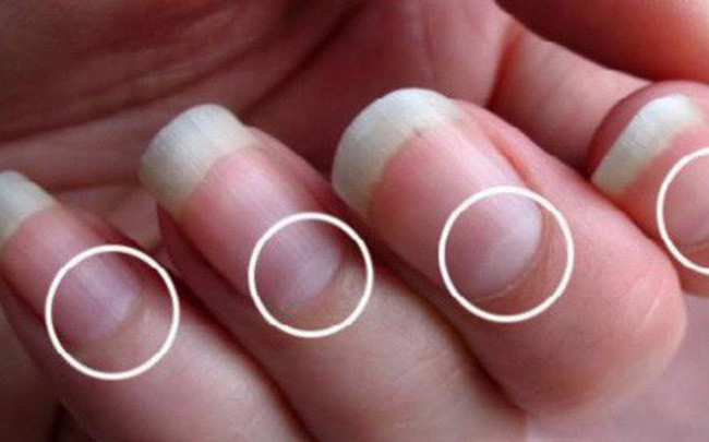 Móng tay có những dấu hiệu này báo hiệu nội tạng mắc bệnh nguy hiểm Mong tay co nhung dau hieu nay bao hieu noi tang mac benh nguy hiem