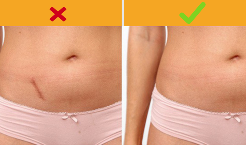 Phẫu thuật cắt ruột thừa có thể dẫn đến bệnh Parkinson: Các chuyên gia đã phát hiện ra rằng, những người phẫu thuật cắt ruột thừa bị mắc phải bệnh Parkinson nhiều gấp 3 lần thông thường.