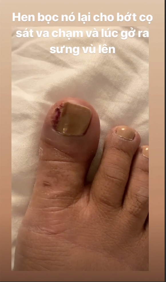 H'Hen chia sẻ trên Instagram hình ảnh ngón chân sưng to, mưng mủ, lở và chảy máu kèm những chia sẻ bản thân phải chịu đau đớn khi mang giày cao gót dự sự kiện.