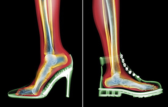 Hơn nữa, với tần suất sử dụng giày cao gót liên tục và thường xuyên, xương khớp đầu gối sẽ bị tổn thương. Do vậy, sớm hay muộn, việc mang giày cao gót quá nhiều sẽ dẫn đến nguy cơ mắc bệnh viêm xương khớp mãn tính ở phụ nữ.