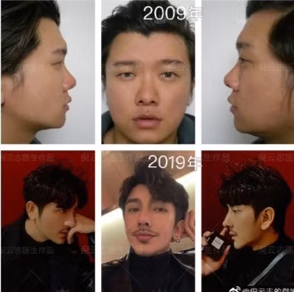 Vì nổi tiếng với gương mặt "đẹp không góc chết" nên khi thông tin và hình ảnh về việc Ngô Tông từng nhiều lần phẫu thuật thẩm mỹ khiến dân mạng không khỏi bất ngờ, tò mò. Trong bức ảnh chụp màn hình khi xuất hiện trong video livestream hồi năm 2016, từ gương mặt đến vóc dáng của anh đều khác xa hiện tại.