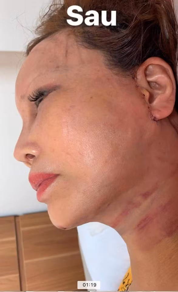 Sau gần 1 tháng phẫu thuật thẩm mỹ, chị Thu Sao thu hút được nhiều sự chú ý khi đăng tải loạt ảnh khoe nhan sắc hậu phẫu.