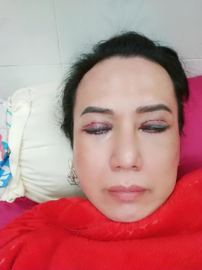 Dù cô có trang điểm khi livestream nhưng không thể che phủ hết những đường nét chưa hoàn thiện sau lần phẫu thuật này.