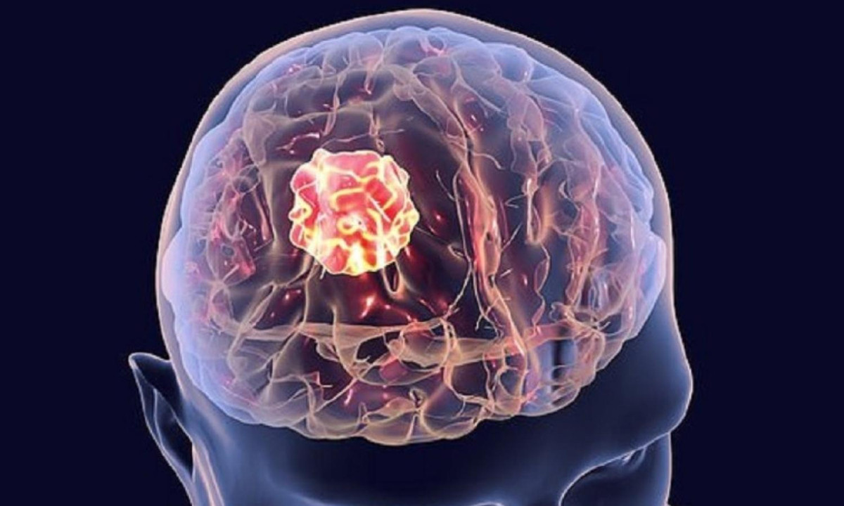 Các nhà nghiên cứu đã khám phá thấy rằng những người bị bệnh déjà vu kinh niên thường bị tổn thương não, đặc biệt là những tổn thương ở vùng thái dương hoặc vùng trước mặt. (Nguồn: tamlitrilieunhc.com) 