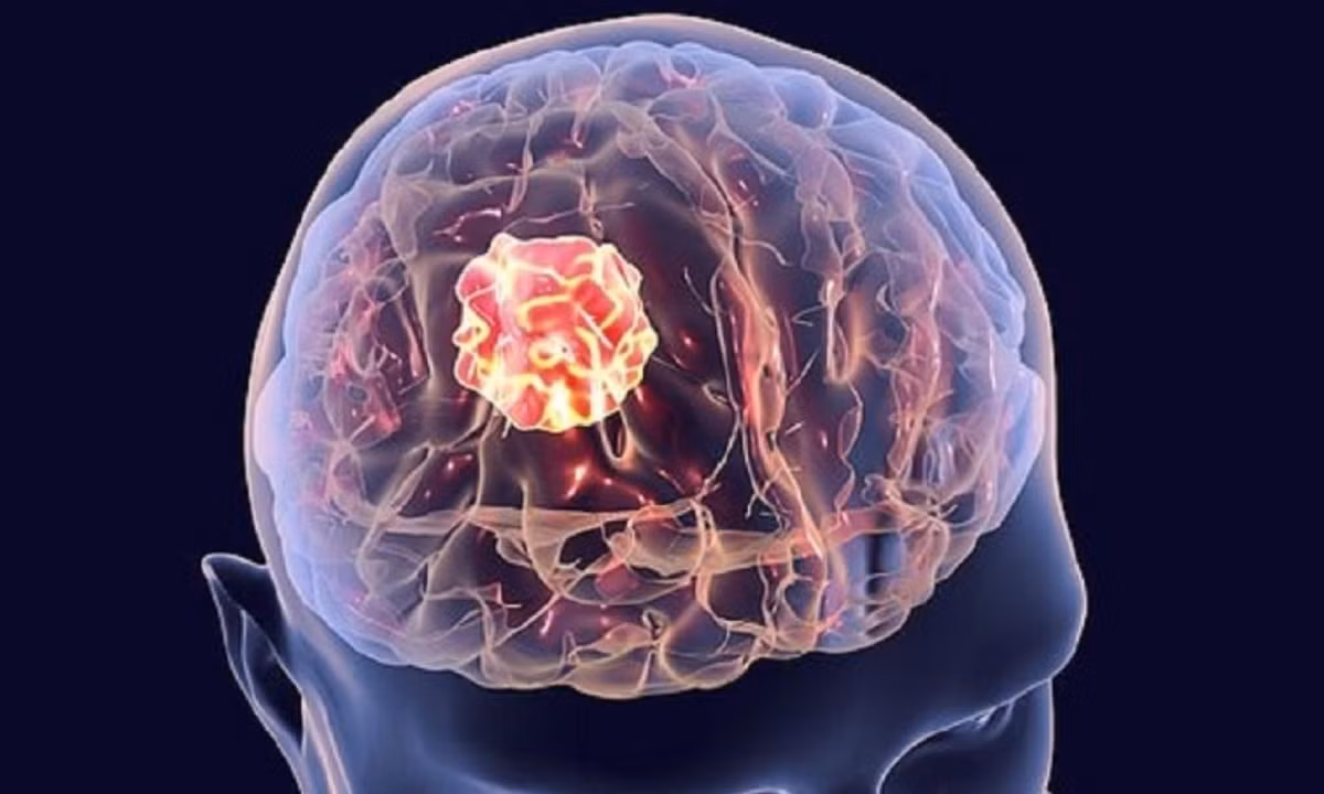 Các nhà nghiên cứu đã khám phá thấy rằng những người bị bệnh déjà vu kinh niên thường bị tổn thương não, đặc biệt là những tổn thương ở vùng thái dương hoặc vùng trước mặt. (Nguồn: tamlitrilieunhc.com) 