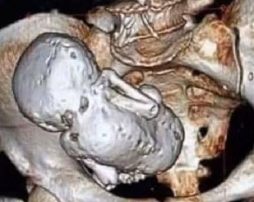 Thai nhi nam trong bung suot 35 nam ma me khong hay biet