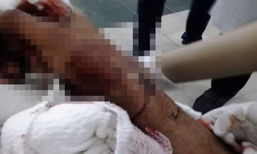 Chu quan an sang bi chem dut roi ban tay