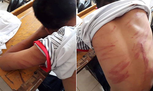 79 vet thuong tren nguoi, nam sinh lop 8 hoang hot ke lai chuyen bi bo de bao hanh