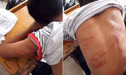 79 vet thuong tren nguoi, nam sinh lop 8 hoang hot ke lai chuyen bi bo de bao hanh