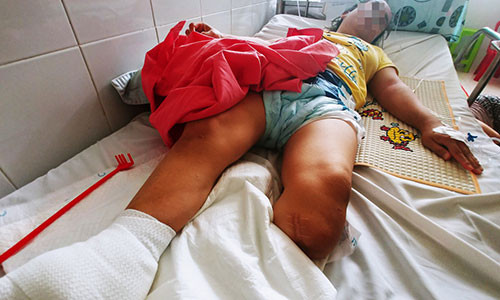 Nguoi phu nu 32 nam khong the di dung, phai cua chan