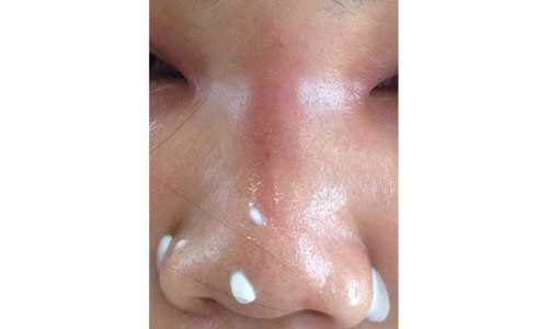 Phần mũi, mặt sưng vù, mưng mủ của chị A. - ẢNH DO BỆNH VIỆN CUNG CẤP