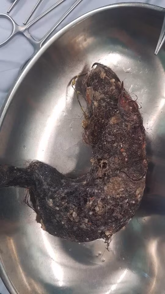 TP.HCM: Phat hien gan 1kg toc trong da day be gai 6 tuoi-Hinh-3