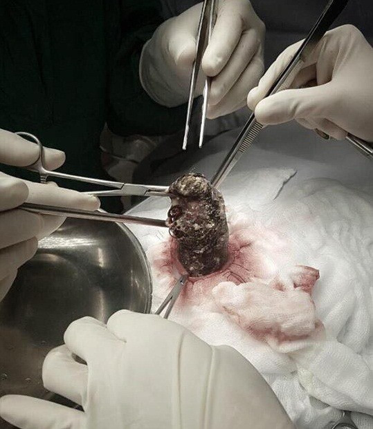 TP.HCM: Phat hien gan 1kg toc trong da day be gai 6 tuoi-Hinh-2