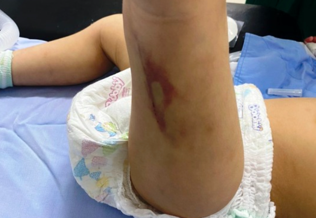 Do trường tổng kết năm học, từ ngày 24/6, Đào đưa L. về nhà chăm sóc. Sau đó, vì sửa nhà nên Đào giao L. lại cho Vy và đưa 2 triệu đồng lo chi phí. Thời gian này, Huỳnh Thị Thanh Hằng (em chồng Vy) cũng phụ trông L. Do L. ít nói chuyện với mọi người nên Vy - Hằng nhiều lần dùng tay đánh bé. Ngày 8/7, Vy đạp vào người khiến L. ngã. Những ngày sau đó, bé nhiều lần bị ngã đập đầu xuống nền nhà. Đến trưa 16/7, sau khi cho L. ăn, Hằng thấy bé ói, người lạnh, môi tím tái đã cùng Vy gọi điện cho người thân đưa bé đến Bệnh viện Nhi tỉnh Lâm Đồng cấp cứu. Tại đây, qua chẩn đoán, L. bị chấn thương sọ não, dập phổi phải mổ cấp cứu. 