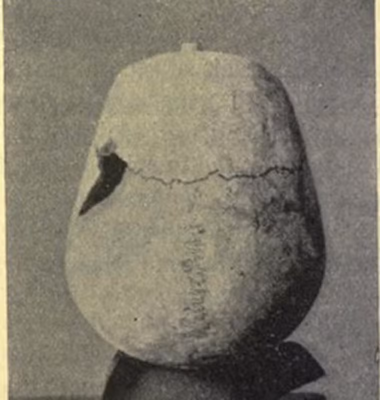 Những chiếc xương dài cung cấp bằng chứng về sự phát triển vượt trội, dấu hiệu rõ ràng của bệnh khổng lồ (gigantism). Phát hiện này chỉ ra vị pharaoh Ai Cập này là trường hợp lâu đời nhất mắc chứng bệnh này trong lịch sử. Không có thành viên nào khác trong hoàng gia Ai Cập có cơ thể cao lớn như vậy.