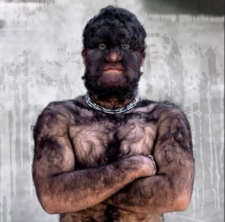 Ngoài ra, các nhà khoa học phát hiện một số ít người trên thế giới mắc hội chứng "người sói". Đây là một dạng bệnh lý hiếm gặp nhất thế giới với xác suất 1/1.000.000 người. Người mắc hội chứng này sẽ có cơ thể nhiều lông, đen, rậm ở nhiều nơi trên cơ thể như ở mặt, lưng, cổ...