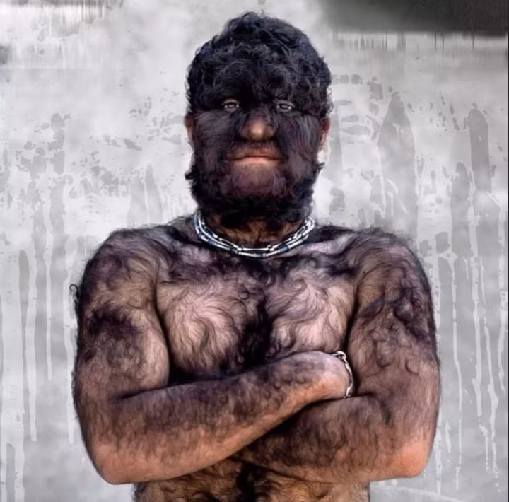 Ngoài ra, các nhà khoa học phát hiện một số ít người trên thế giới mắc hội chứng "người sói". Đây là một dạng bệnh lý hiếm gặp nhất thế giới với xác suất 1/1.000.000 người. Người mắc hội chứng này sẽ có cơ thể nhiều lông, đen, rậm ở nhiều nơi trên cơ thể như ở mặt, lưng, cổ...