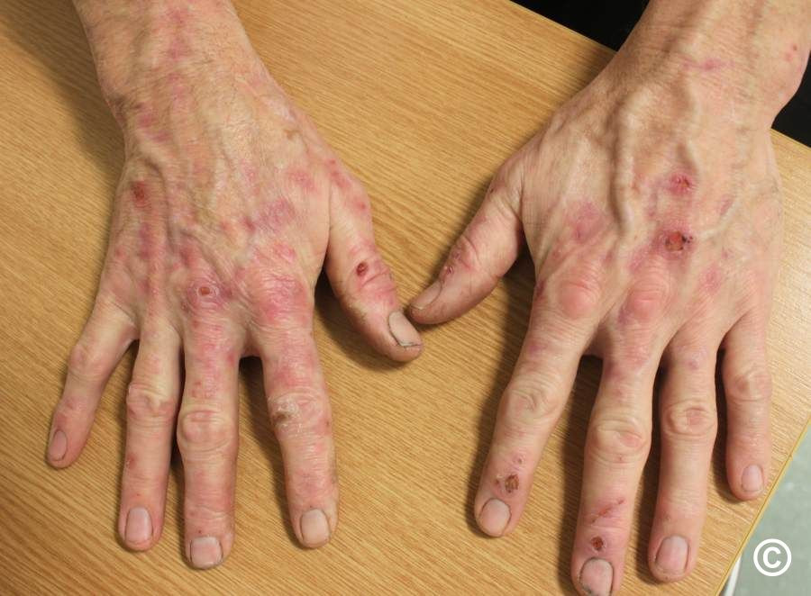 Những trường hợp nghiêm trọng có thể gần bị biến dạng, những ngón tay co quắp lại, da quanh môi và lợi bị khô, răng cửa nhô lên và ngả sang màu đỏ.