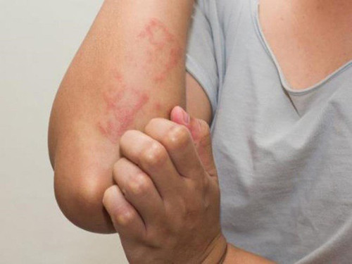 Thuốc chống dị ứng. Du xuân dịp Tết, cơ thể có thể bị dị ứng với các yếu tố như môi trường, thực phẩm, khí hậu,... Do vậy, bạn nên chuẩn bị thuốc chống dị ứng. Các loại thuốc chống dị ứng phổ biến bao gồm viên loratadine, viên levocetirizine hydrochloride, viên nén giải phóng kéo dài mizolastine và các thuốc kháng histamine khác.