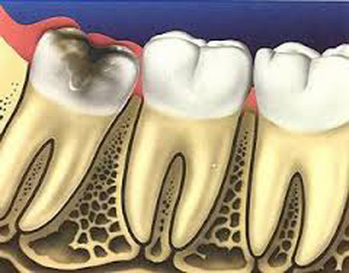 Qua quá trình tiến hóa, phần quai hàm của con người ngày càng trở nên nhỏ hơn và răng khôn không còn đủ chỗ để mọc đúng vị trí. Ngoài ra, thuở sơ khai, con người thường phải gặm xương nhiều và vệ sinh kém nên răng của họ bị gãy rụng nhiều. Do đó, sự hiện diện của các răng hàm dự trữ, hay còn gọi răng khôn là một yếu tố sống còn.