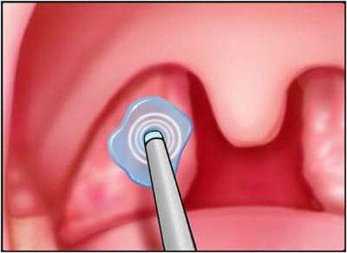 Amidan. Amidan được hình thành bởi các mô bạch huyết – một phần của hệ bạch huyết có ý nghĩa quan trọng đối với hệ miễn dịch. Trong khi đó, khoang miệng là nơi đưa thức ăn vào cơ thể. Các tế bào miễn dịch ở khu vực này giúp bạn chống lại các bệnh viêm đường hô hấp. Đôi khi amidan có thể bị viêm và khi đó nó cần được loại bỏ.