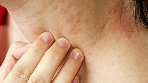 Eczema. Eczema còn được biết đến là tình trạng viêm da dị ứng. Eczema gây nên các đốm đỏ ngứa ngáy tập trung ở bàn tay, chân, cổ, ngực và mí mắt. Việc tiếp xúc với chất tẩy rửa mạnh, thời tiết lạnh khắc nghiệt, lông vật nuôi, hút thuốc và căng thẳng khiến tình trạng trở nên trầm trọng. Nguyên nhân chính xác của Eczema chưa thực sự rõ ràng song bệnh không có khả năng lây truyền.