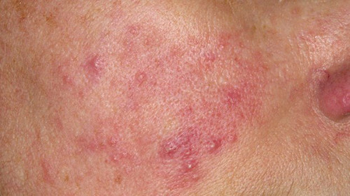 Rosacea. Rosacea là một trong những vấn đề về da phổ biến và thường ảnh hưởng đến da mặt. Bệnh làm da trở nên đỏ ở các vùng mũi, cằm, má và trán. Nguyên nhân gây bệnh rosacea chưa rõ ràng song có nhiều giả thuyết khác nhau tồn tại. Một giả thuyết cho rằng bệnh rosacea có thể là do rối loạn tổng quát các mạch máu.
