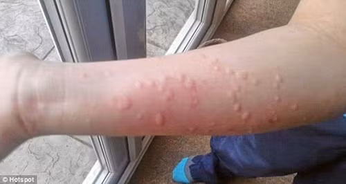 Mề đay có thể xuất hiện vài phút hoặc kéo dài hàng giờ song dễ dàng được điều trị bằng thuốc kháng antihistamine. Trường hợp mề đay kéo dài hàng tuần, bạn nên đi khám bác sĩ để được hướng dẫn điều trị triệt để.