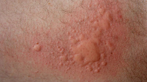 Mề đay. Người mắc chứng mề đay thường có biểu hiện ngứa, nốt mề đay khá đa dạng về kích cỡ lẫn hình dạng. Bệnh thường là kết quả của tình trạng dị ứng, chẳng hạn dị ứng khi ăn các loại hạt, sữa, trứng, tôm cua và trái cây họ cam quýt. Đôi khi, mề đay xuất hiện do côn trùng đốt hoặc tác dụng phụ khi dùng thuốc.