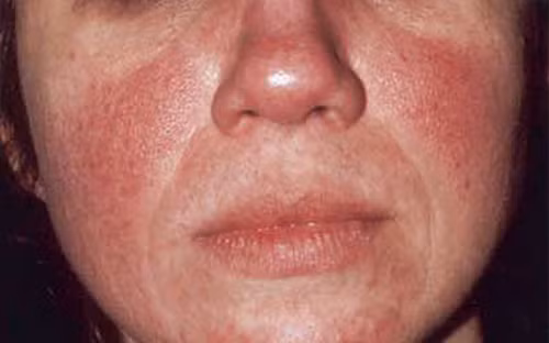 Các giả thuyết khác cho rằng tình trạng này bắt nguồn từ ve, nấm, yếu tố tâm lý, hoặc một sự bất thường của các mô liên kết dưới da.